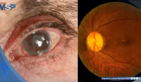 Dispositivo permite drenaje efectivo del l&iacute;quido ocular y promete mejores resultados en el glaucoma