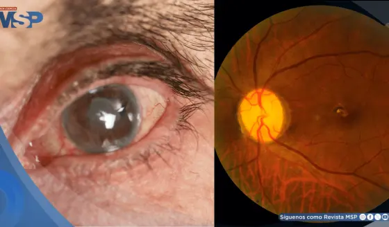 Dispositivo permite drenaje efectivo del líquido ocular y promete mejores resultados en el glaucoma