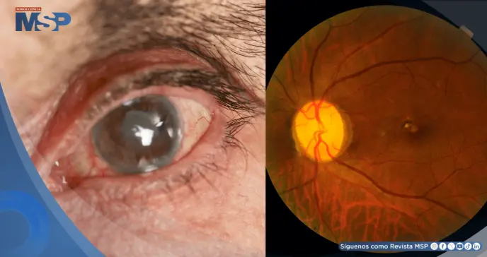Dispositivo permite drenaje efectivo del líquido ocular y promete mejores resultados en el glaucoma