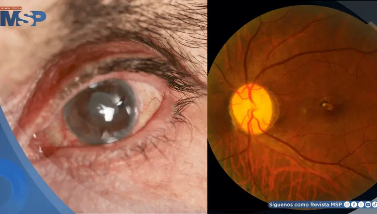 Dispositivo permite drenaje efectivo del líquido ocular y promete mejores resultados en el glaucoma