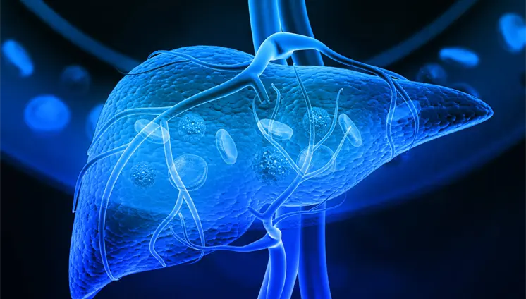 Mini-examen clínico: Evalúe sus conocimientos sobre cáncer de hígado Mini-examen clínico: Evalúe sus conocimientos sobre cáncer de hígado