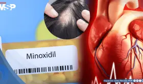 El minoxidil oral a dosis bajas demuestra ser seguro para el corazón en el tratamiento de la alopecia