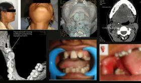Infección de la muela del juicio retenida ocasiona parálisis del nervio hipogloso en mujer de 23 años