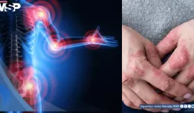 Artritis psoriásica después de los 60 años presenta más comorbilidades y menor acceso a biológicos
