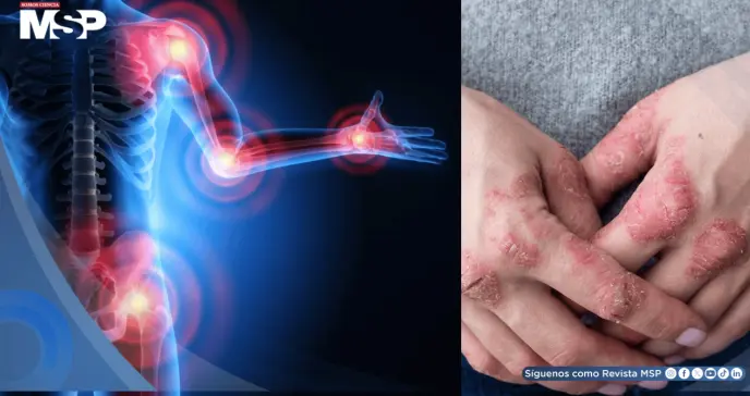 Artritis psoriásica después de los 60 años presenta más comorbilidades y menor acceso a biológicos