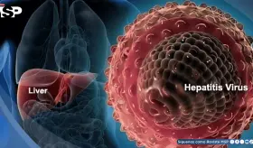 ¿Fatiga constante, dolor abdominal o piel amarillenta? Podrían ser síntomas de hepatitis autoinmune