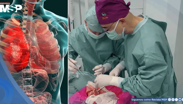 Logran el primer trasplante de pulmón de cerdo modificado genéticamente a un humano Logran el primer trasplante de pulmón de cerdo modificado genéticamente a un humano