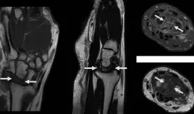Paciente con fractura vertebral previa desarrolla edema y dolor por Kienböck estadio IV en mano derecha 