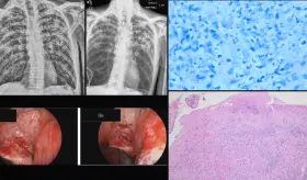 Presentación inusual de tuberculosis extrapulmonar como masa laríngea en un paciente atípico