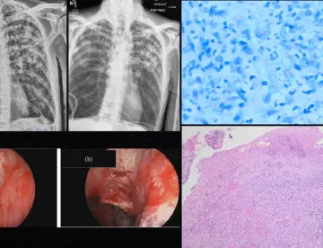 Presentación inusual de tuberculosis extrapulmonar como masa laríngea en un paciente atípico