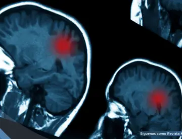 Traumatismos craneoencefálicos moderados y graves aumentan el riesgo de tumores cerebrales malignos