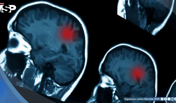 Traumatismos craneoencefálicos moderados y graves aumentan el riesgo de tumores cerebrales malignos
