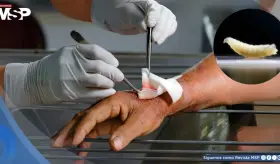 Detectan en EE. UU. primer caso humano del gusano ‘come carne’, capaz de provocar miasis: Lo que debe sab