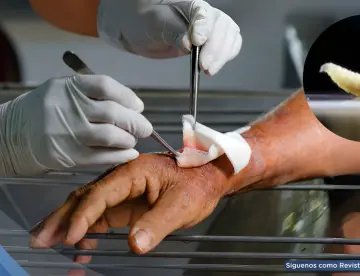 Detectan en EE. UU. el primer caso humano del gusano ‘come carne’: Una infestación poco común en personas
