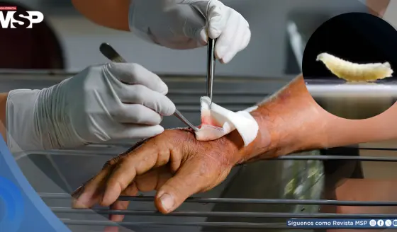 Detectan en EE. UU. el primer caso humano del gusano ´come carne´: Una infestación poco común en personas