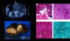 Basidiobolomicosis gastrointestinal es confundida con colitis ulcerosa en paciente con masa abdominal
