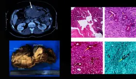 Basidiobolomicosis gastrointestinal es confundida con colitis ulcerosa en paciente con masa abdominal
