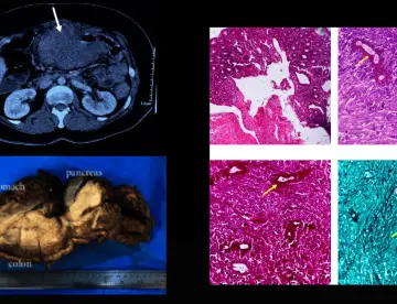 Basidiobolomicosis gastrointestinal es confundida con colitis ulcerosa en paciente con masa abdominal