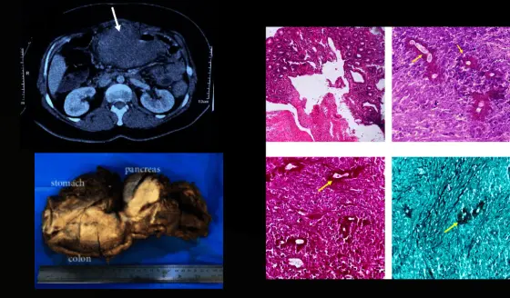 Basidiobolomicosis gastrointestinal es confundida con colitis ulcerosa en paciente con masa abdominal