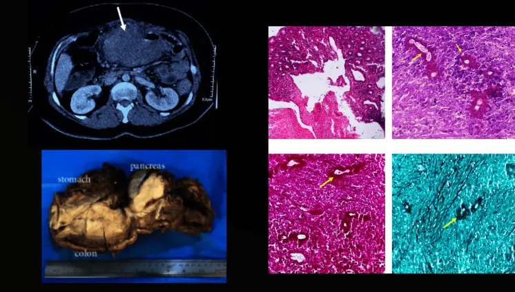Basidiobolomicosis gastrointestinal es confundida con colitis ulcerosa en paciente con masa abdominal