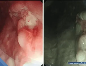 Detectan úlcera gastroesofágica causada por infección de VPH tipo 16 en hombre de 71 años