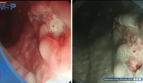 Detectan úlcera gastroesofágica causada por infección de VPH tipo 16 en hombre de 71 años