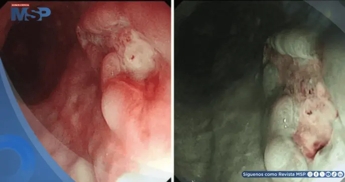 Detectan úlcera gastroesofágica causada por infección de VPH tipo 16 en hombre de 71 años