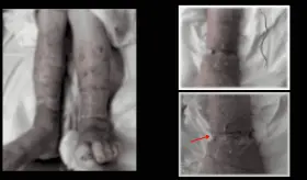 Banda elástica olvidada como causa de úlcera con necrosis en extremidad inferior de paciente con diabetes