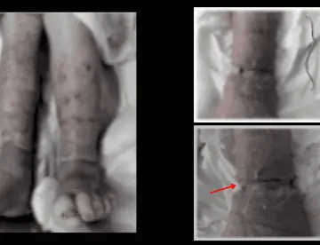 Banda elástica olvidada como causa de úlcera con necrosis en extremidad inferior de paciente con diabetes
