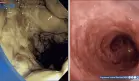 Enema de café ocasiona proctocolitis grave y necrosis de tejido intestinal
