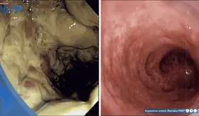 Enema de café ocasiona proctocolitis grave y necrosis de tejido intestinal