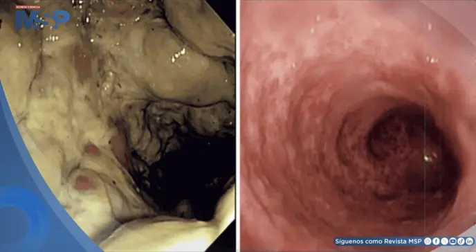 Enema de café ocasiona proctocolitis grave y necrosis de tejido intestinal