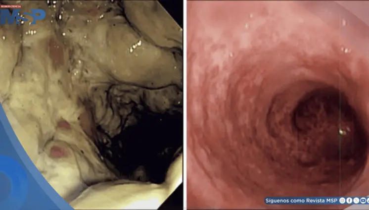 Enema de café ocasiona proctocolitis grave y necrosis de tejido intestinal