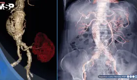 Descubren que el exceso de azúcares debilitaría la aorta y provoca aneurismas: así podrían prevenirlos