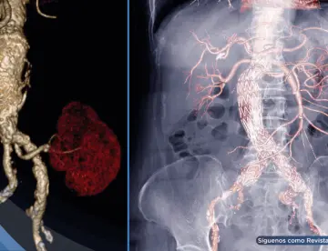 Descubren que el exceso de azúcares debilitaría la aorta y provoca aneurismas: así podrían prevenirlos