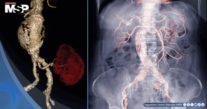 Descubren que el exceso de azúcares debilitaría la aorta y provoca aneurismas: así podrían prevenirlos