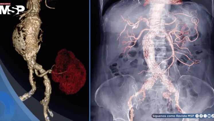 Descubren que el exceso de azúcares debilitaría la aorta y provoca aneurismas: así podrían prevenirlos