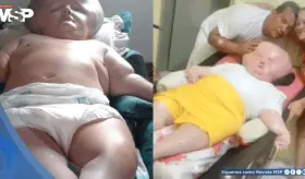 Madre mantiene viva a su hija con hidrocefalia y síndrome de rubéola congénita: Le daban 3 meses de vida