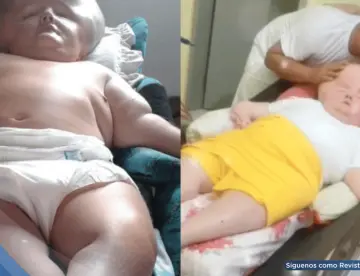 Madre mantiene viva a su hija con hidrocefalia y síndrome de rubéola congénita: Le daban 3 meses de vida