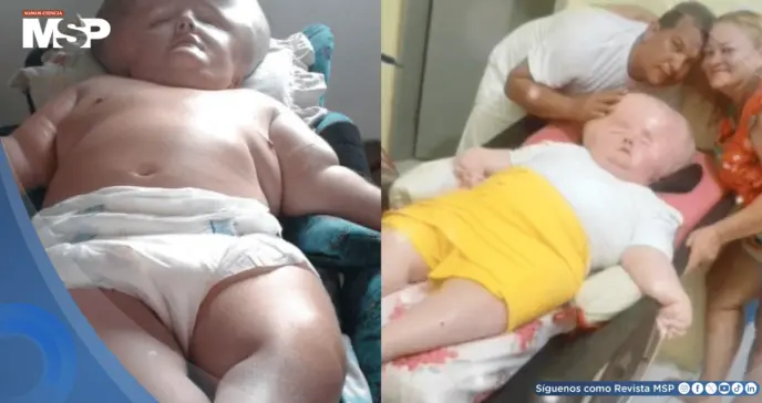 Madre mantiene viva a su hija con hidrocefalia y síndrome de rubéola congénita: Le daban 3 meses de vida