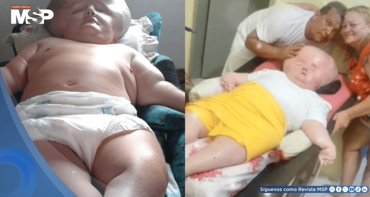 Madre mantiene viva a su hija con hidrocefalia y síndrome de rubéola congénita: Le daban 3 meses de vida