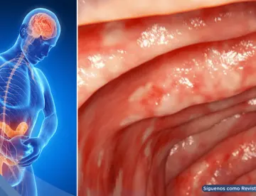 Por qué ciertos mecanismos del tabaco benefician a la colitis ulcerosa y cómo replicarlos sin fumar