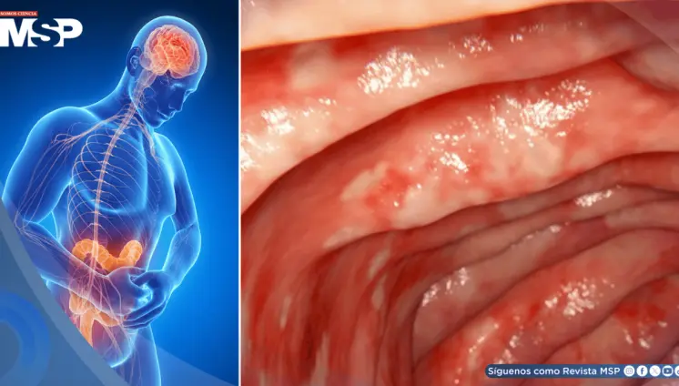 Por qué ciertos mecanismos del tabaco benefician a la colitis ulcerosa y cómo replicarlos sin fumar