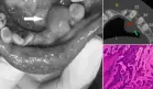 Describen caso de ameloblastoma que simulaba hiperplasia gingival, localizado en mandíbula inflamada
