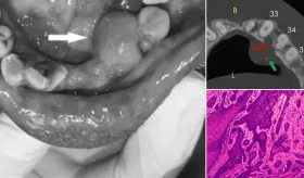 Describen caso de ameloblastoma que simulaba hiperplasia gingival, localizado en mandíbula inflamada