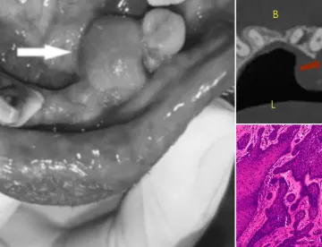 Describen caso de ameloblastoma que simulaba hiperplasia gingival, localizado en mandíbula inflamada