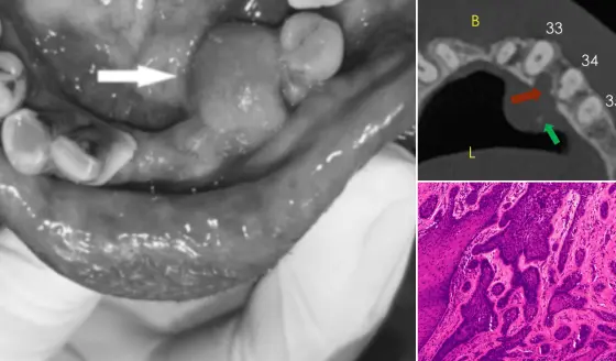 Describen caso de ameloblastoma que simulaba hiperplasia gingival, localizado en mandíbula inflamada