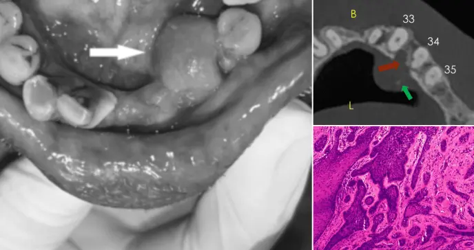 Describen caso de ameloblastoma que simulaba hiperplasia gingival, localizado en mandíbula inflamada