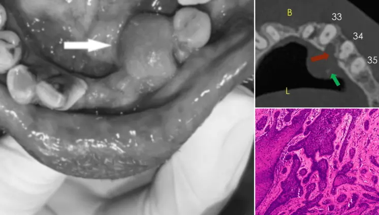 Describen caso de ameloblastoma que simulaba hiperplasia gingival, localizado en mandíbula inflamada