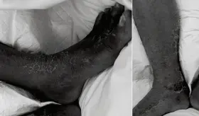 Bacteria marina causa infección en la pierna de un hombre de 75 años con diabetes y psoriasis 